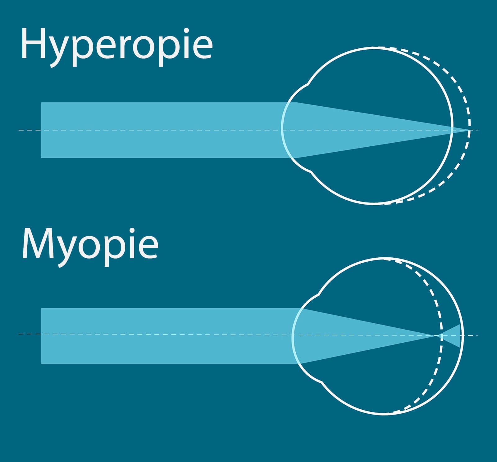 Myopie und Hyperopie